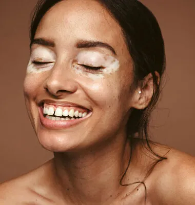 Embrace the Colors of Diversity: Celebrating World Vitiligo Day and the Power of Inclusivity