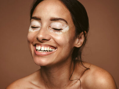 Embrace the Colors of Diversity: Celebrating World Vitiligo Day and the Power of Inclusivity