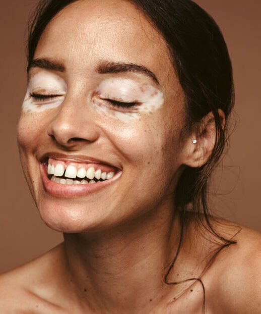 Embrace the Colors of Diversity: Celebrating World Vitiligo Day and the Power of Inclusivity