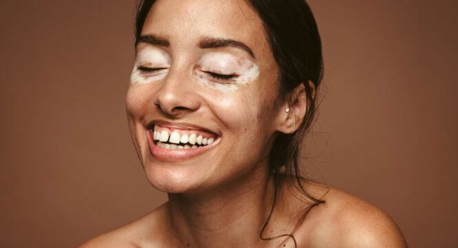 Embrace the Colors of Diversity: Celebrating World Vitiligo Day and the Power of Inclusivity