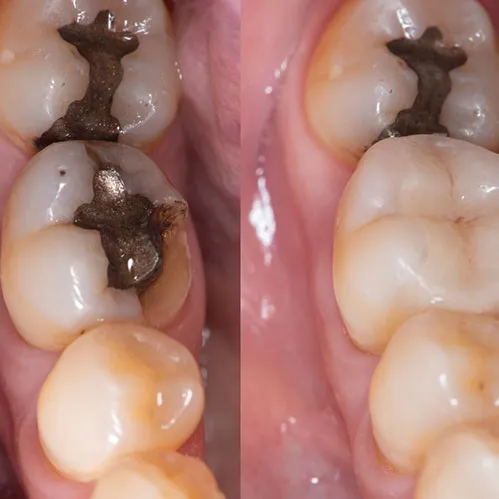 Before and after dental filling