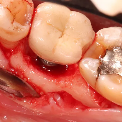 Teeth infection