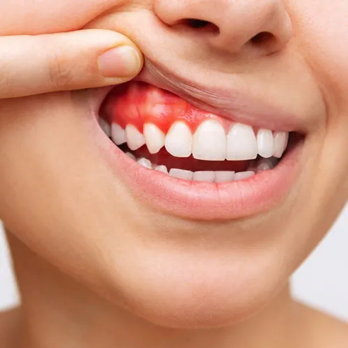 Inflammation on gums