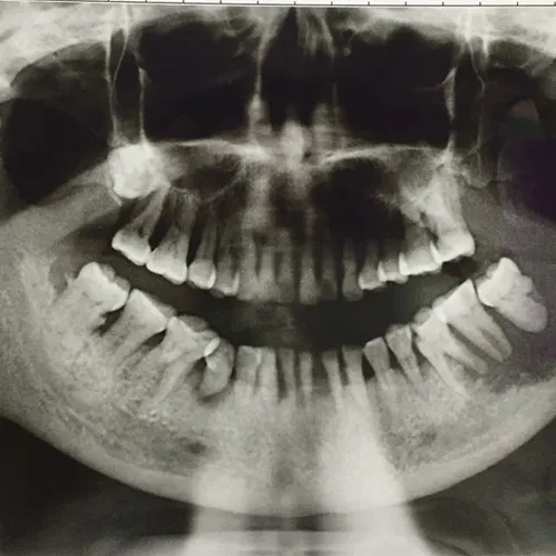 X-ray of Oral Cancer