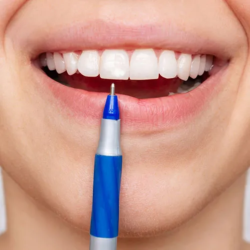White Spots o teeth