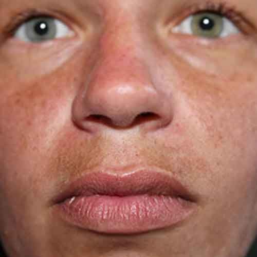 Women with Melasma