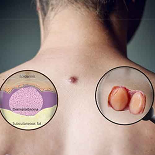 Representation of skin tag on women body