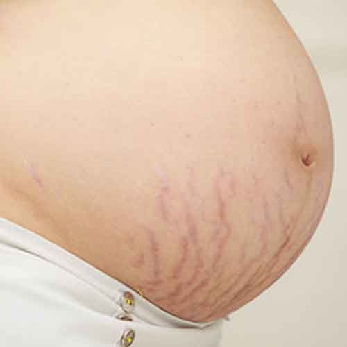 Representation of stretch mark on women's belly