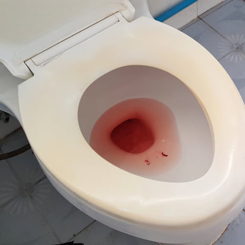 Blood in the Urine