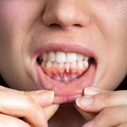 Women with Receding Gum