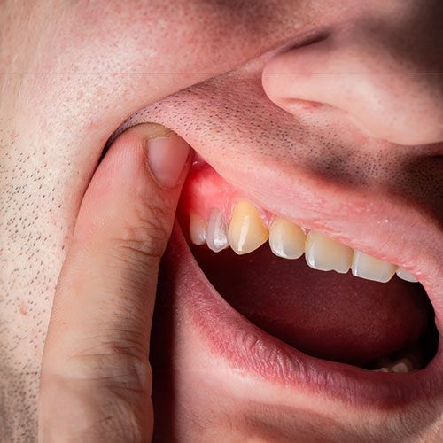 Man showing his red swollen gum